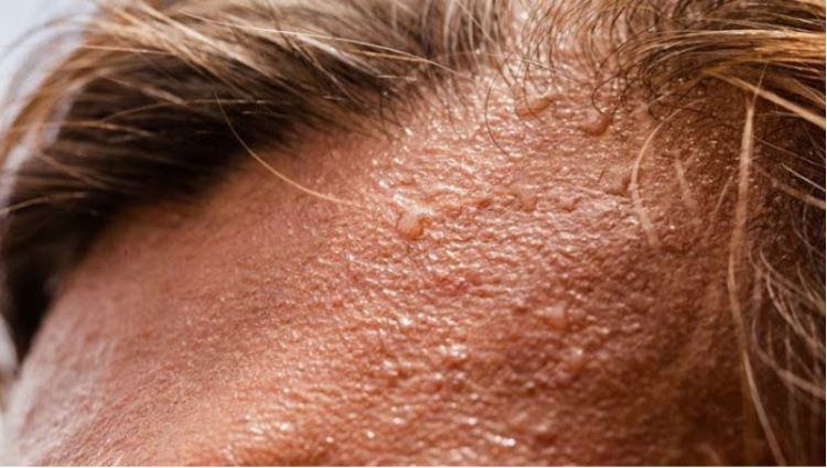 Đổ mồ hôi đầu do chứng tăng tiết mồ hôi - Hyperhidrosis